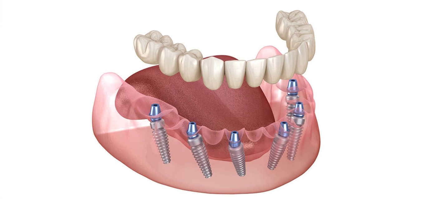 Full Mouth Dental Implants Clinic in Kanpur