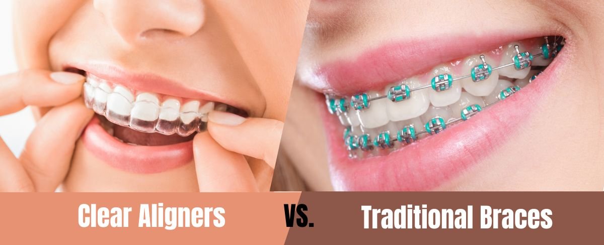Clear Aligners vs. Traditional Braces