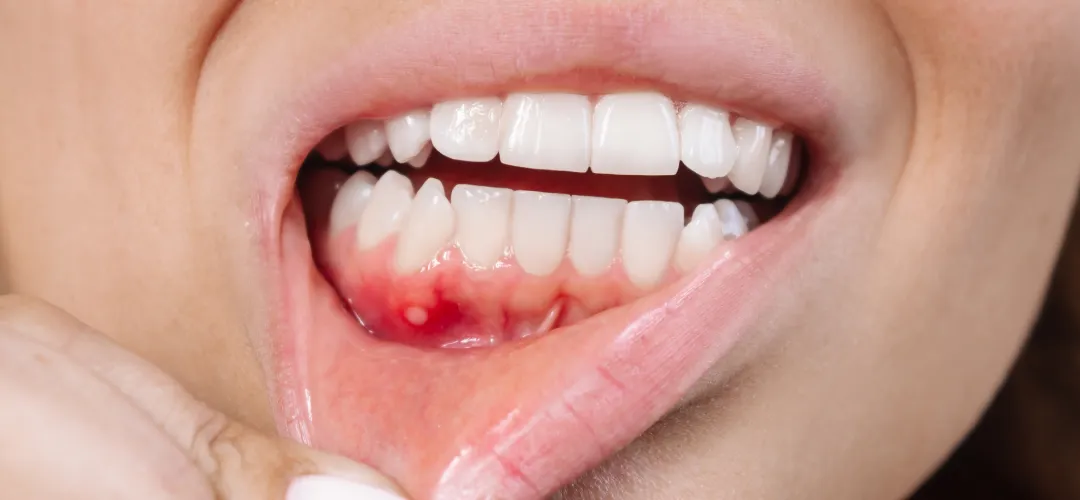 Best Dentist for Mouth Ulcer Treatment in Sharda Nagar