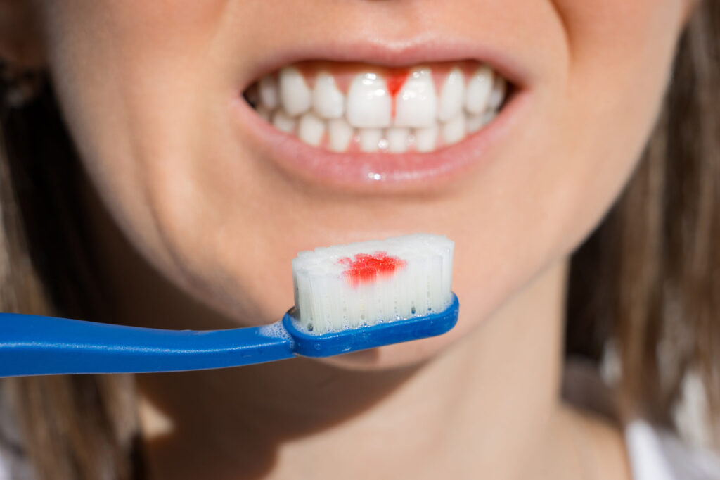 Top Dentist for Bleeding Gums Treatment in Kanpur