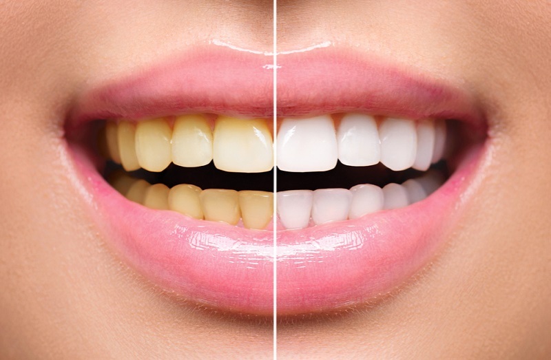 Best Dentist for Yellow Tooth Treatment in Kanpur