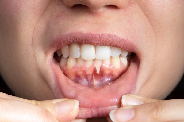 Best Dental Clinic for Gum Infection Treatment in Kanpur