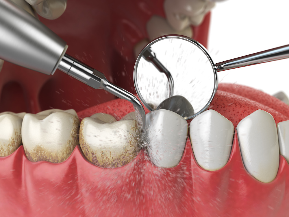 Best Deep teeth Cleaning Treatment in Swaroop Nagar