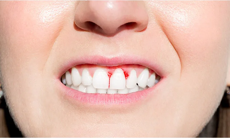 Why Do Gums Bleed?